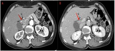 MSH6 germline mutations leading to Lynch syndrome-associated cholangiocarcinoma: a case report